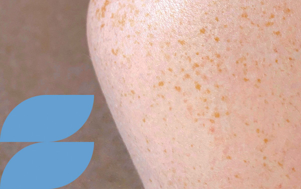 Especialidad Dermatología Vista Clinic